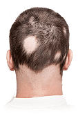 Micropigmentación contra la Alopecia