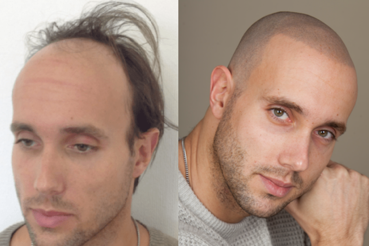 la micropigmentación es la solución para la alopecia androgenética