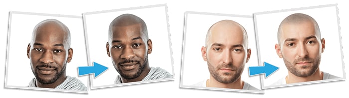 micropigmentación del cuero cabelludo antes y después