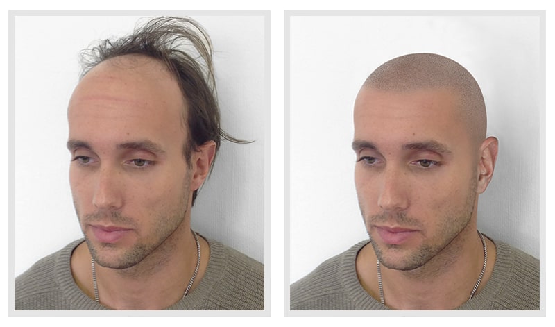 Scalp Micropigmentation Virtual Hairline Mock-up