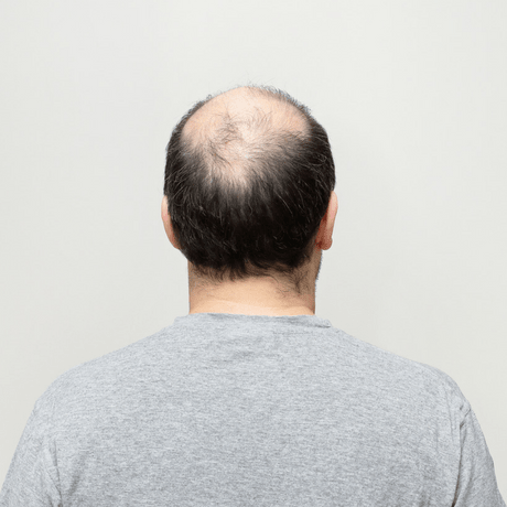 Calvas pelo -De Pérdida De Pelo Que Puede Arreglar La Micropigmentación Capilar