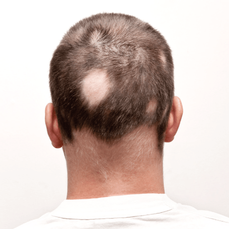 Parches de alopecia