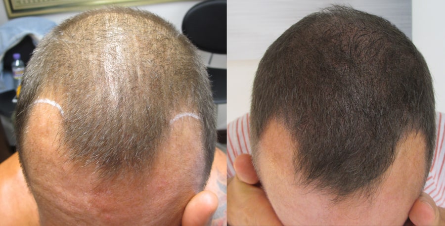 ejemplo de micropigmentación del cuero cabelludo con cabello largo
