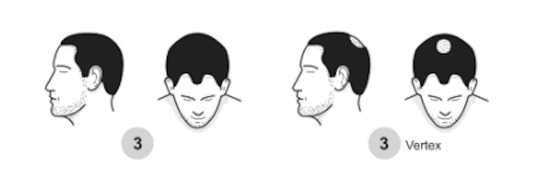 etapas 3 de la pérdida de pelo masculina