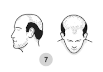 7 etapas de la pérdida de pelo masculina